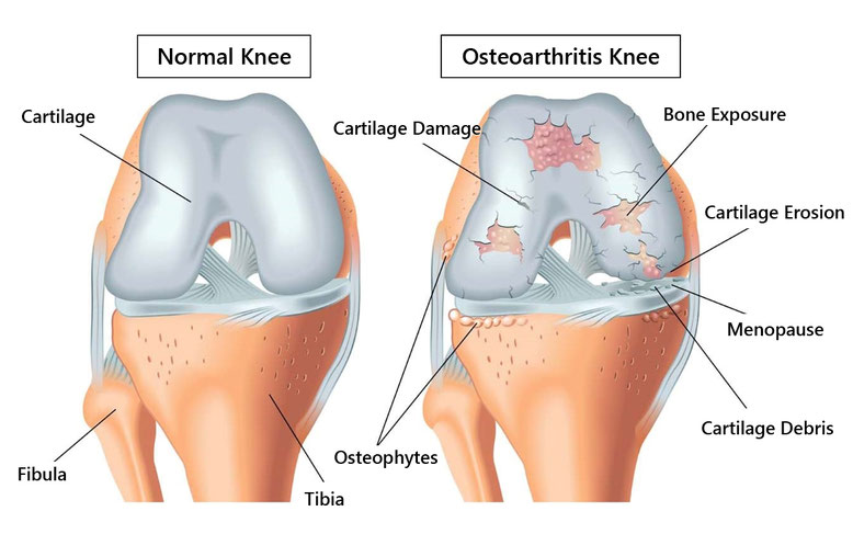 Early Osteoarthritis Treatment without Knee Replacement